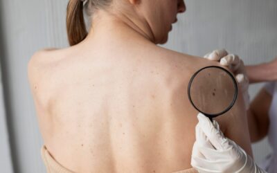 Scopriamo insieme il melanoma: come prevenirlo, diagnosticarlo e curarlo